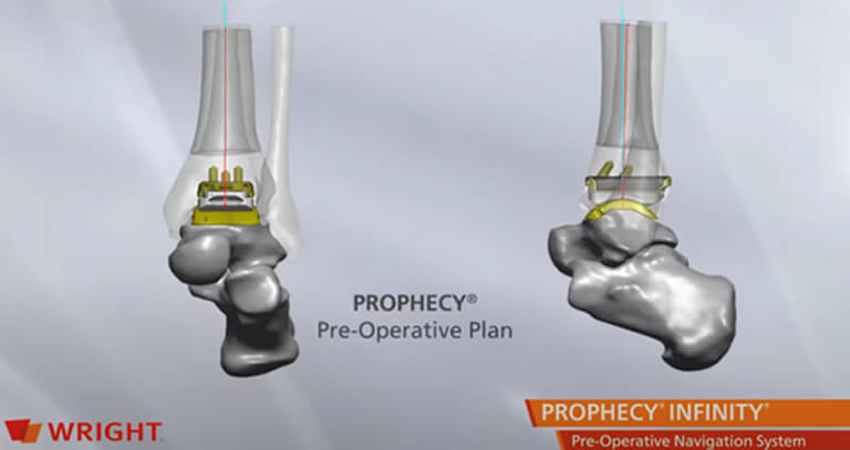 Prophecy-Pre-Operative-Plan