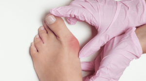 Bunion in woman foot on white background